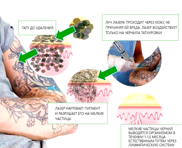 Удаление татуировок Екатеринбург, вывести татуировку цена  Академическая клиника